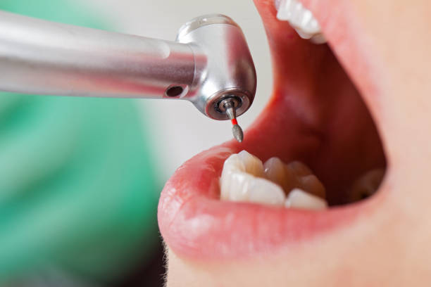 Best Chipped Tooth Repair Near Me  in North Browning, MT